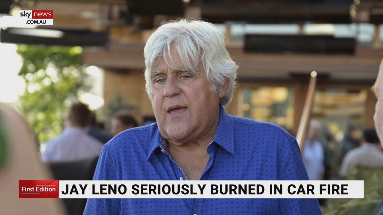 Jay Leno seriously burnt after car fire